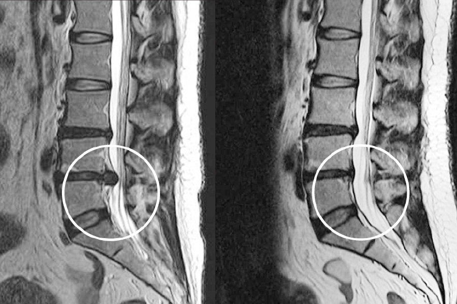 增強脊椎自生能力後，突出的腰椎間盤慢慢返回去原來的位置，使患者腰椎恢復正常。 