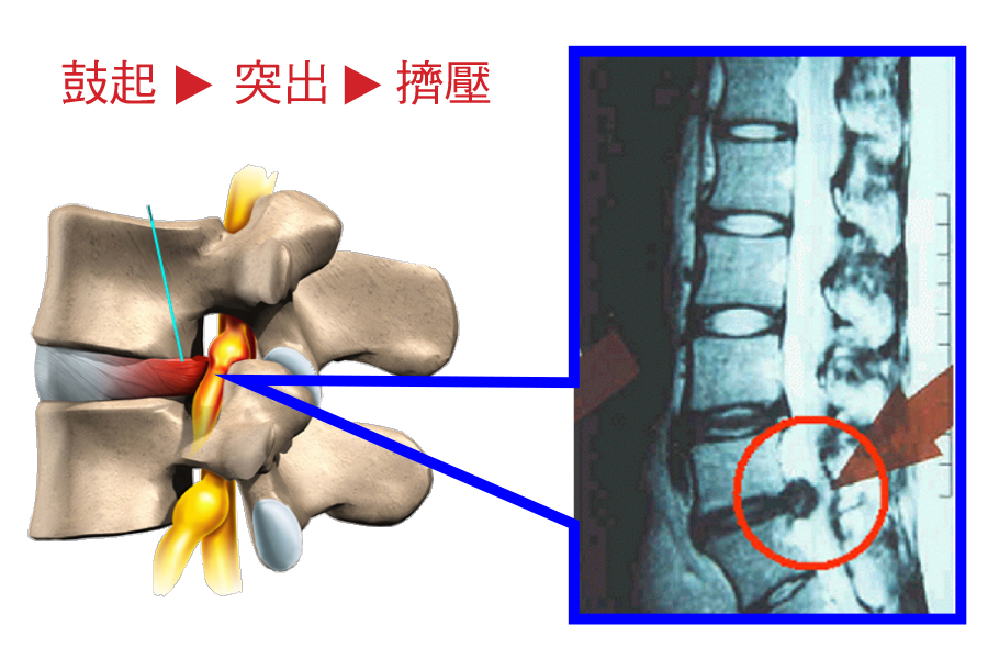椎間盤突出嚴重就會壓迫脊椎，從而造成腳趾、腳腕或膝蓋以下出現麻痺。