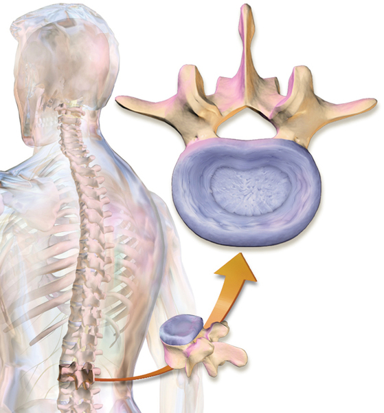 利用幹細胞生成椎間盤 可植入人體作為替代物
