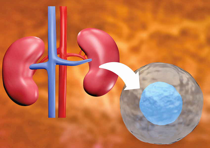幹細胞療法有望替代腎移植術