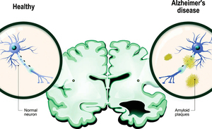 新方法可準確診斷阿茲海默症