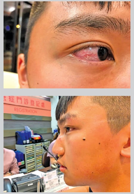 鄭家朗眼被打後疑似微血管爆裂，眼鏡也被打變形。（香港眾志臉書）