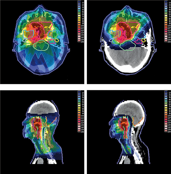 X射線放療和質子放療兩種方法對於鼻咽癌治療方案的對比圖。此圖顯示X射線療法（左側兩圖）對腫瘤周圍正常組織的傷害比質子療法（右側兩圖）要嚴重很多。圖中不同顏色的區域標示出不同程度的放射劑量。（維基百科）