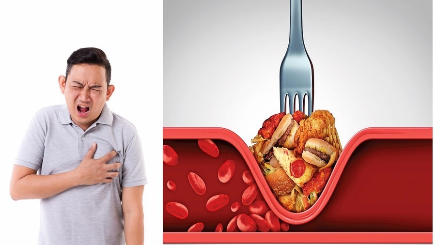 炸物吃太多小心引發心肌梗塞