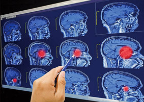 研究：AI診斷腦癌 表現跟醫師一樣準確