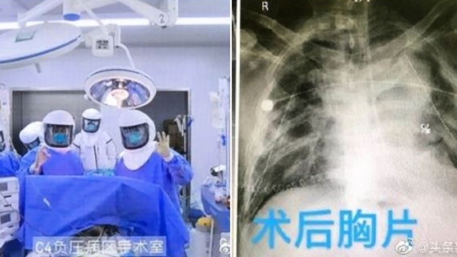 中共肺炎患者雙肺移植惹疑 主刀醫生早被國際追查