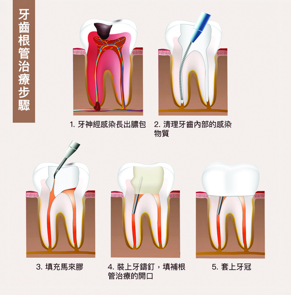 牙齒抽神經就「死」了嗎？  根管治療3問答