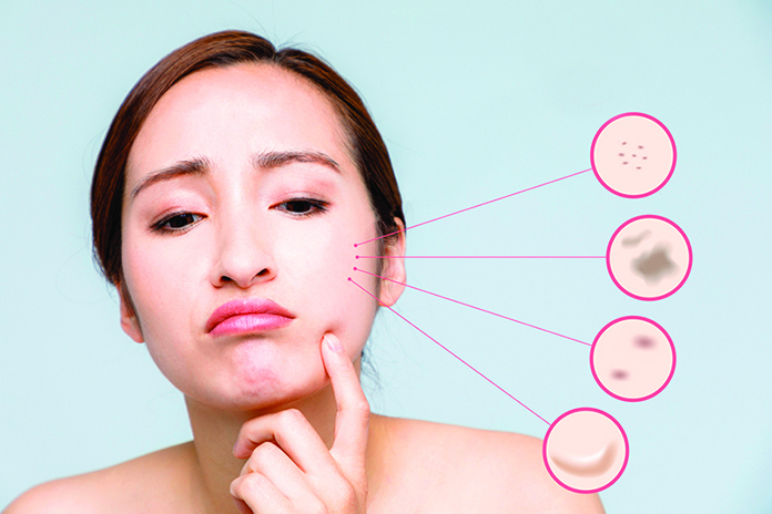 臉上長斑的種類常見有老人斑、雀斑、肝斑和發炎後的色素沉澱。