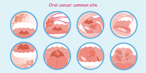 口腔癌有五大異常現象 恐是癌前病變 及早就醫提升存活率