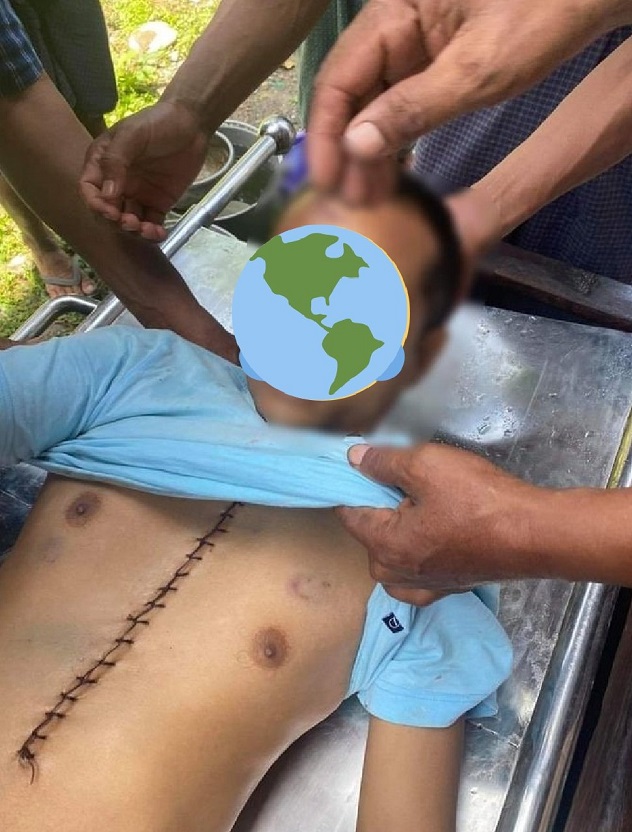 支持民盟的緬甸密鐵拉地區的一個鎮長被逮捕後，軍方交還的屍體被解剖過。（受訪者提供）