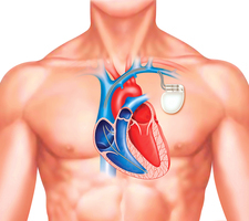 新型心臟起搏器 可在體內自行溶解