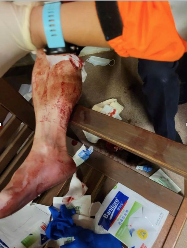 警員右小腿受傷送院，情況穩定。（Bruce Wong／香港突發事故報料區Facebook）