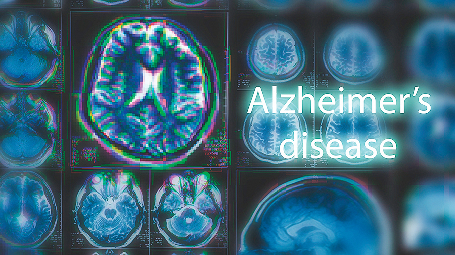 患有阿茲海默症的大腦掃瞄圖像。（Shutterstock）