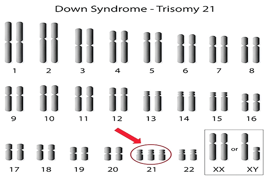 研究發現唐氏症病因與衰老機制類似
