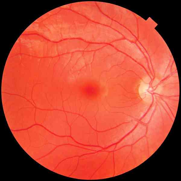研究：視網膜老化情況可預知早逝風險