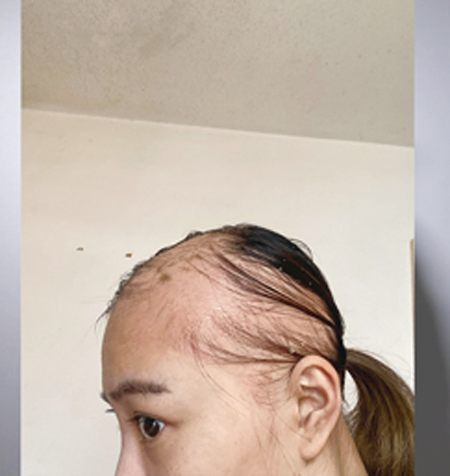 前西貢區議員王卓雅公開自己部份頭髮已長回的照片。（王卓雅Facebook）