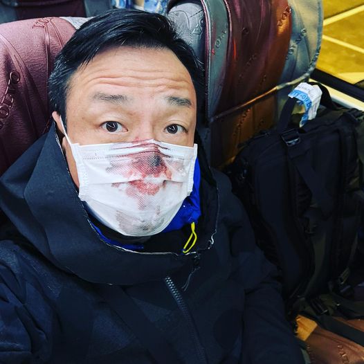 王喜入境台灣時，因爲做PCR核酸檢測時被弄到鼻孔流血。（王喜Facebook圖片）