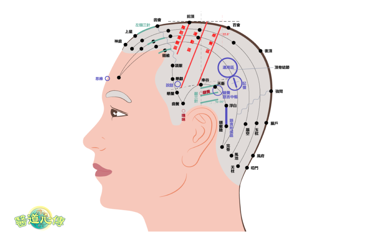 醫道心傳】中醫頭皮針療法
