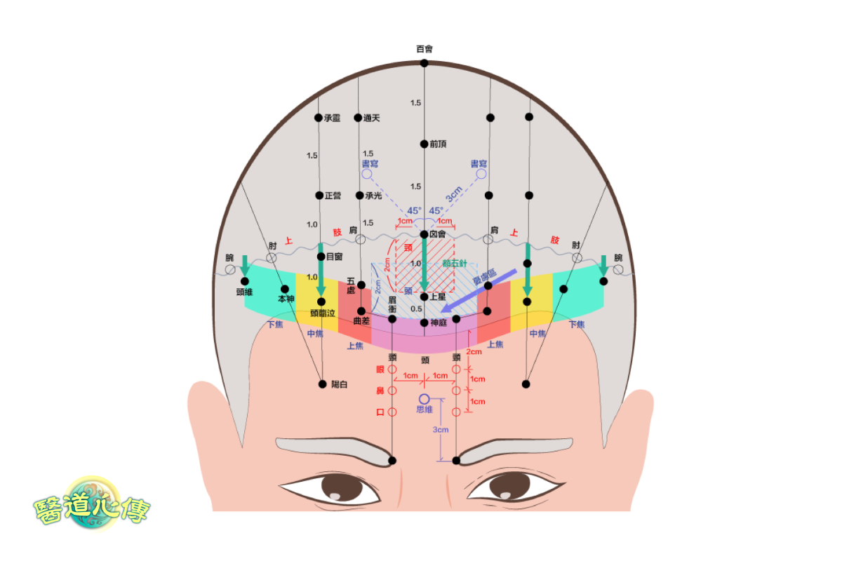 醫道心傳】中醫頭皮針療法