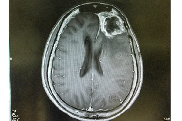 南韓研發出納米級傳輸體 可大大提高腦癌治療效果
