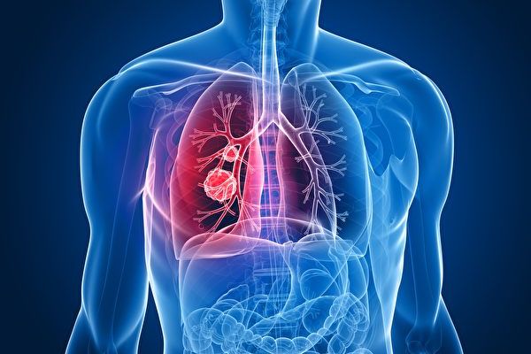 一項研究發現，肺癌患者若術後長期使用阿片類鎮痛藥，在未來2年內比不使用阿片類藥物患者的死亡率增加了40%。（Shutterstock）