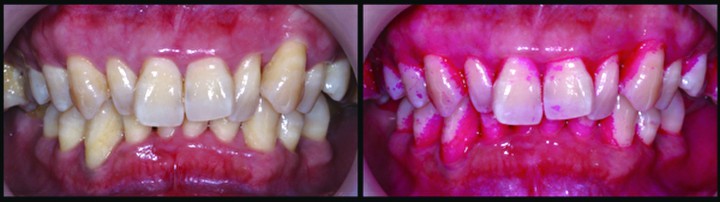 牙縫三角地帶、牙齒與牙齦相連的齒頸部的牙菌斑不容易刷乾淨。（徐志中醫師提供）