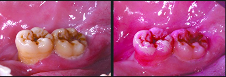 牙齒內側靠近舌頭的部位有大範圍的粉紅色區塊，正是沒有刷乾淨的牙菌斑。（徐志中醫師提供）
