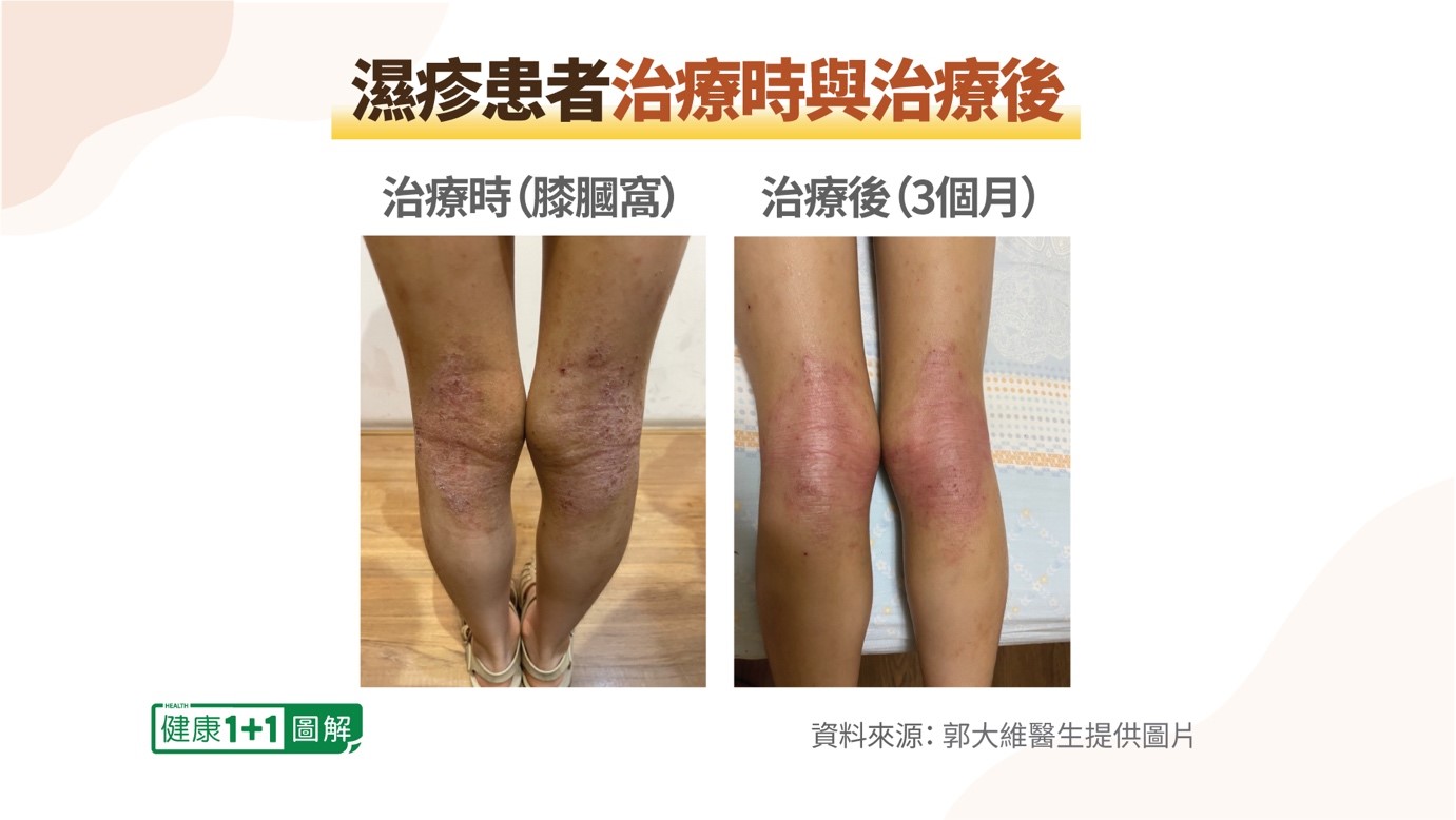 郭大維門診患者，經過治療後，皮膚濕疹顯著改善。（健康1+1）