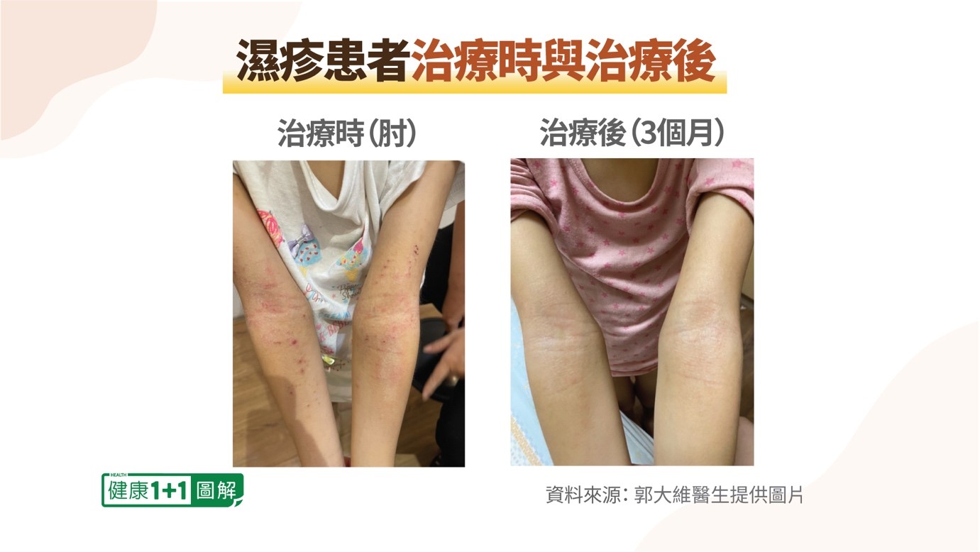 郭大維門診患者，經過治療後，皮膚濕疹顯著改善。（健康1+1）