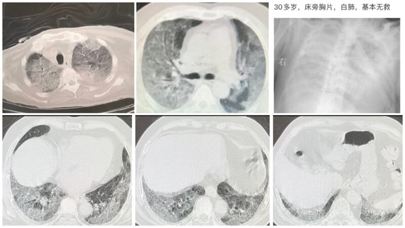 有中國醫生近日在社交媒體上展示大量染疫者「白肺」照片。（網絡截圖）