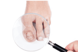 預防和治療灰指甲 你應該知道甚麼？