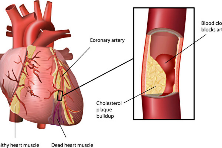 動脈硬化需警惕 常吃這四樣有助血管健康