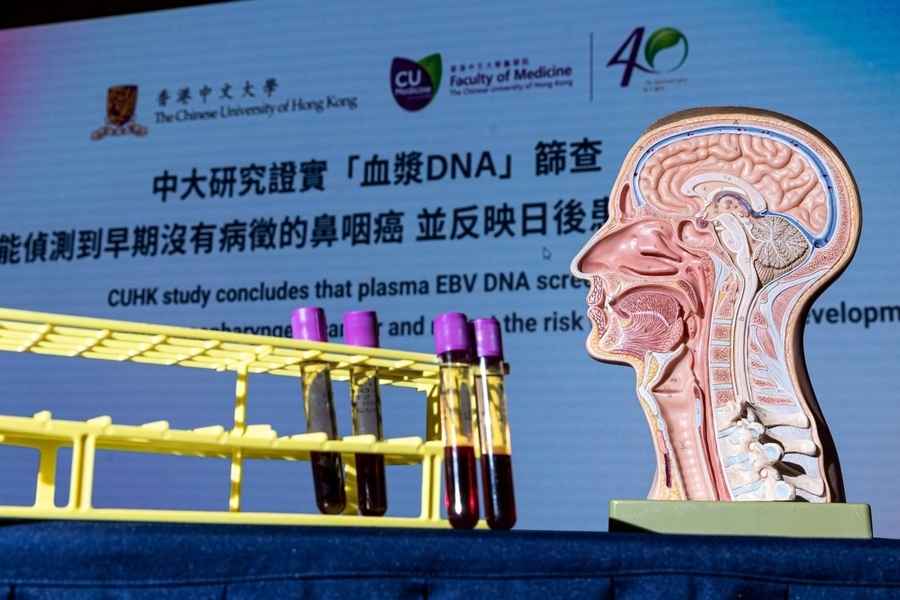 中大研究：血漿DNA篩查可檢測早期鼻咽癌 