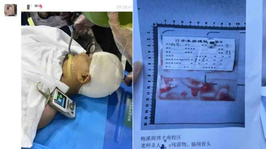 湖南教師打傷九歲女生致開顱手術 點燃民眾怒火