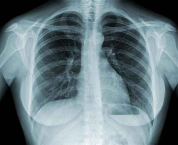 慢性肺病不是不治之症 韓方草藥可清肺
