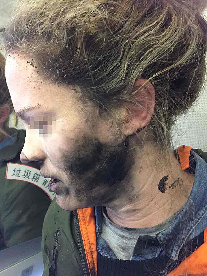 耳機電池在飛機上爆炸 澳洲女子臉部被灼傷