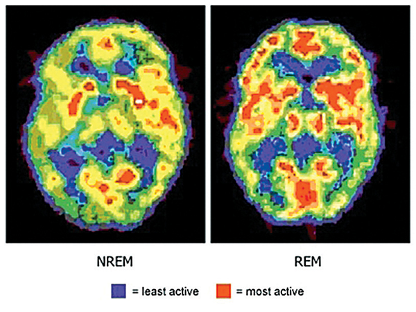 透過正電子掃描（Positron Emission Tomography，簡稱PET Scan）展示在慢波睡眠（NREM）和快速動眼睡眠（REM）時腦部的活躍狀態。紅色部分為最活躍，藍色部分為最不活躍。（網絡圖片）