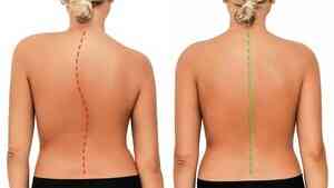 脊椎側彎導致多種疾病 中西醫治療可改善