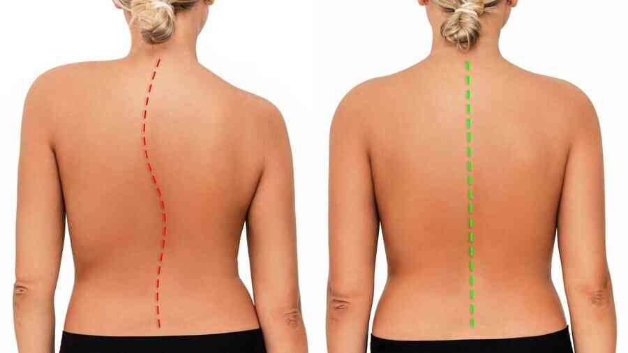 脊椎側彎導致多種疾病 中西醫治療可改善