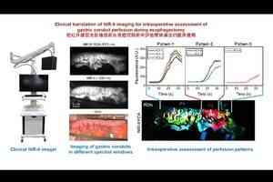 港大新技術 助減切除食道手術風險