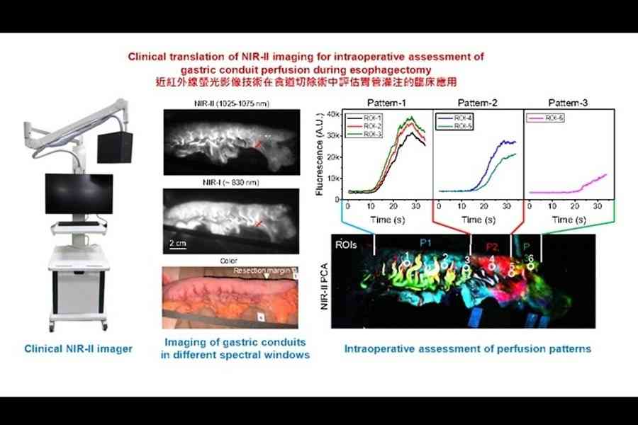 港大新技術 助減切除食道手術風險