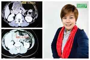 轉變心態 大腸癌末期患者15年不復發