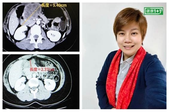 轉變心態 大腸癌末期患者15年不復發