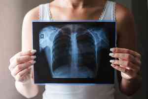 【健康1+1】小細胞肺癌擴散快 醫生揭延命關鍵