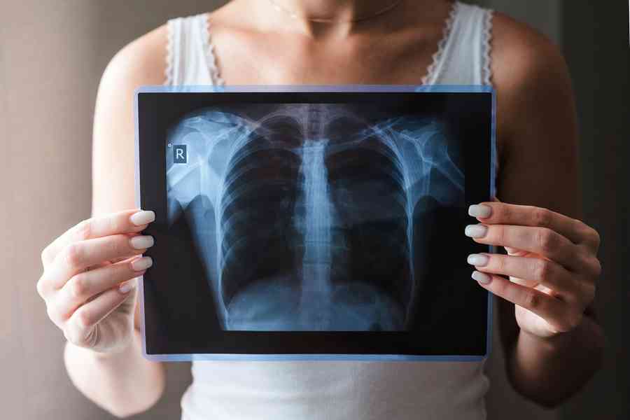 【健康1+1】小細胞肺癌擴散快 醫生揭延命關鍵