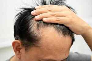 每天一分鐘按摩養頭皮 搭配食療可烏髮