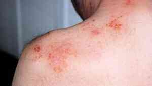 皮膚疾病與心理健康雙向影響 中醫師教你改善方法