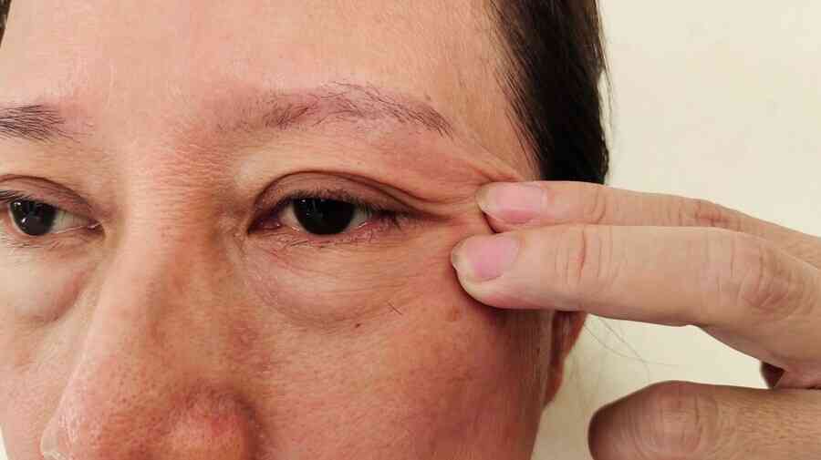 【健康養成記】眼袋明顯怎麼辦？中醫揭3大成因與改善方法