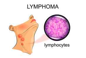 何謂淋巴瘤?