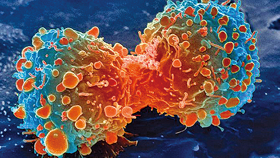 新研究：糖刺激癌細胞生長